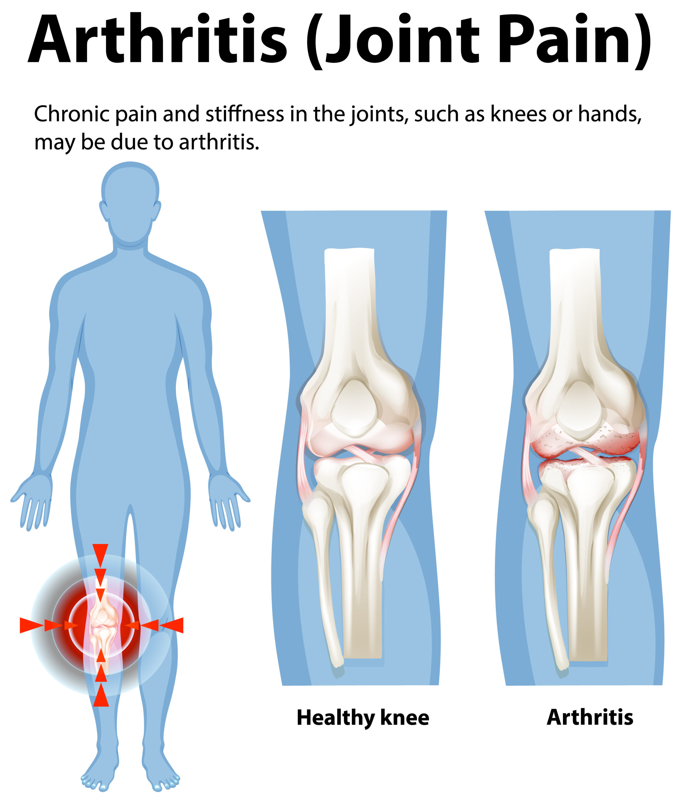 Arthritis Management: Early Signs, Causes, and Treatment Options