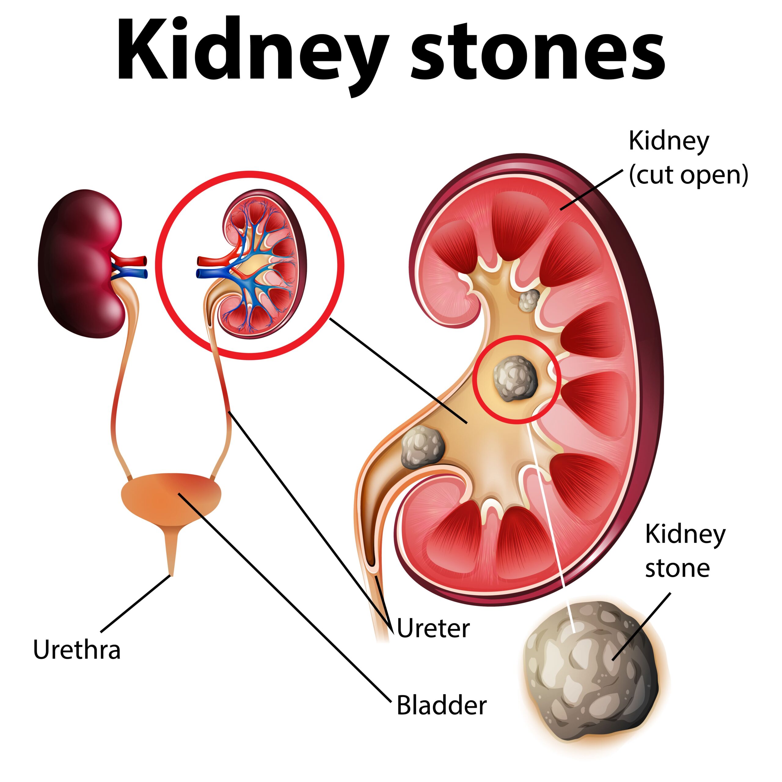 Kidney Stones Treatment: Why Laser Surgery is the Gold Standard